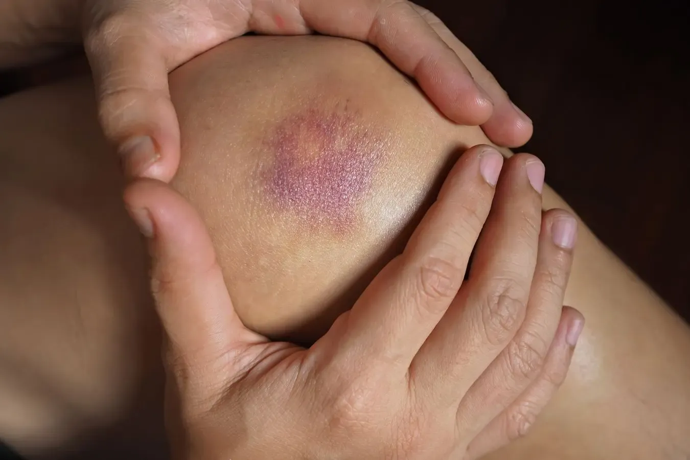 vitamin k for bruising